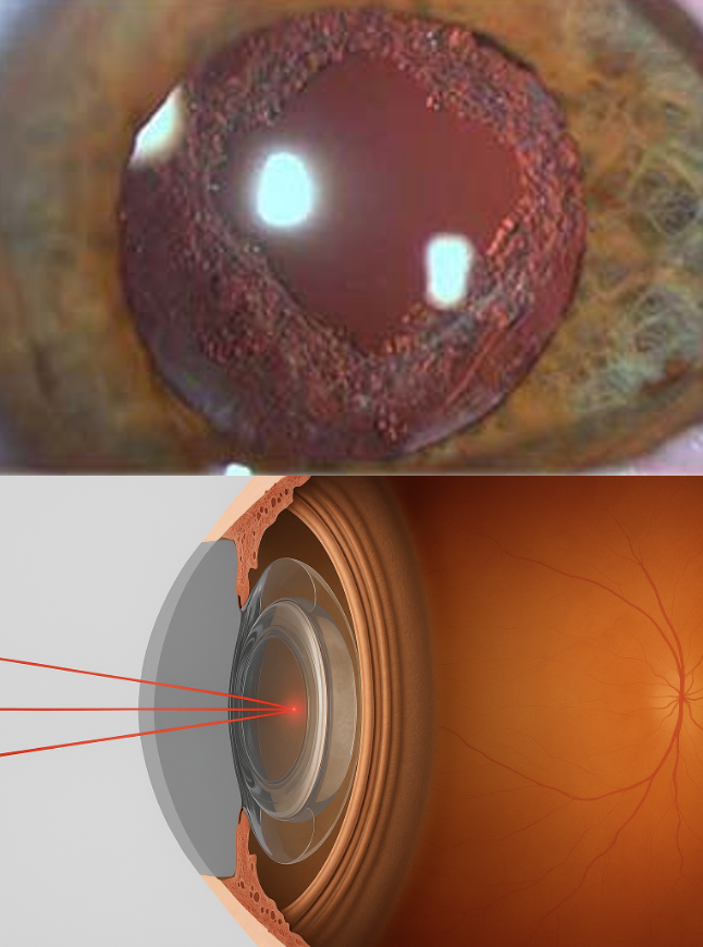Capsulotomía YAG láser
