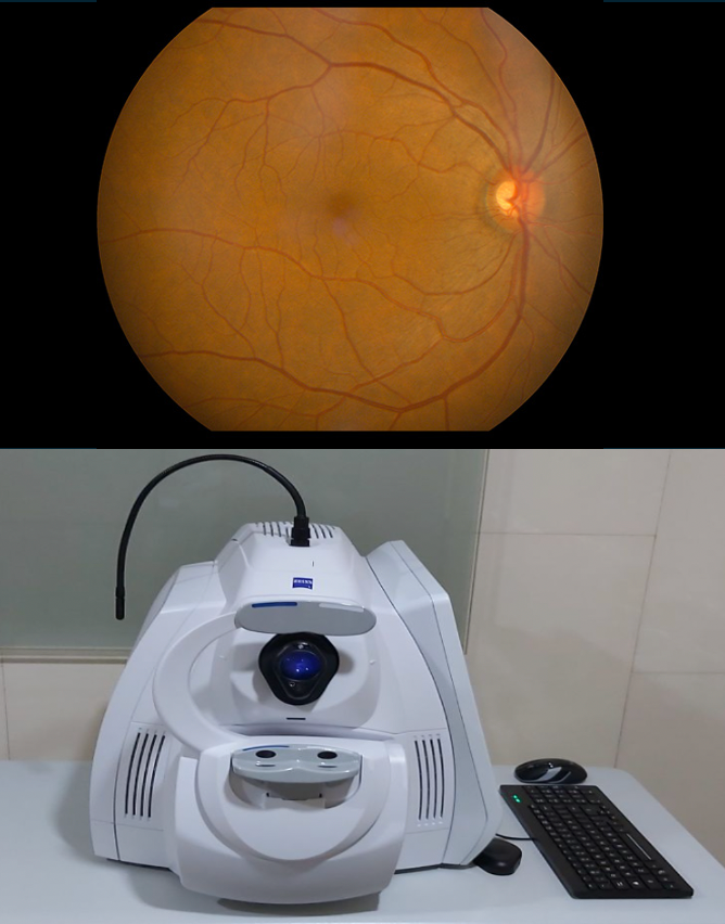 Fotografía de segmento posterior Zeiss Cirrus