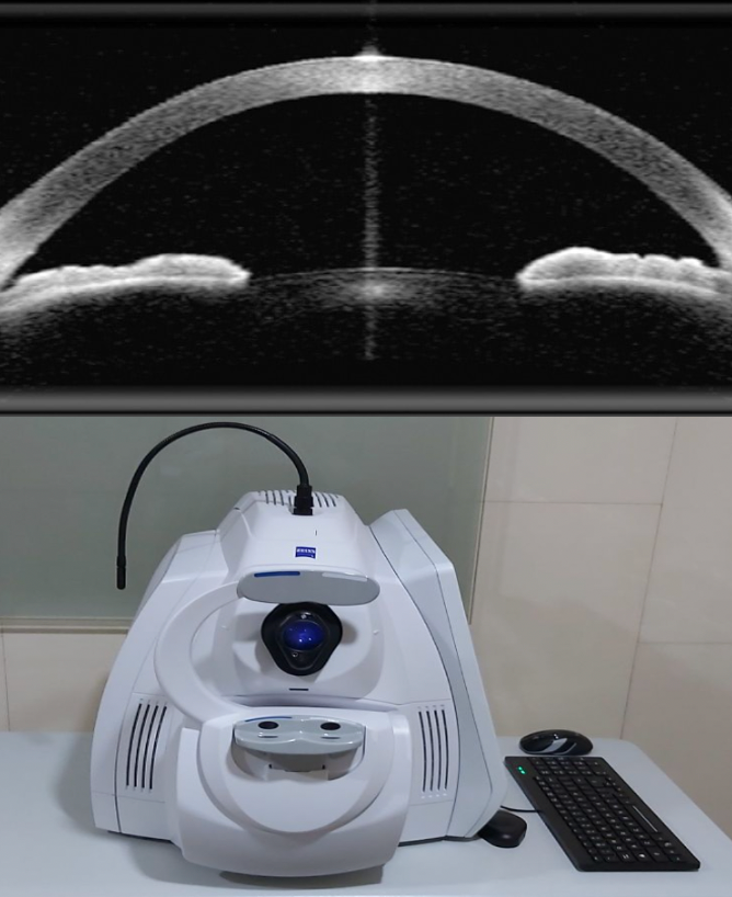 OCT de segmento anterior Zeiss Cirrus - ejemplo córnea