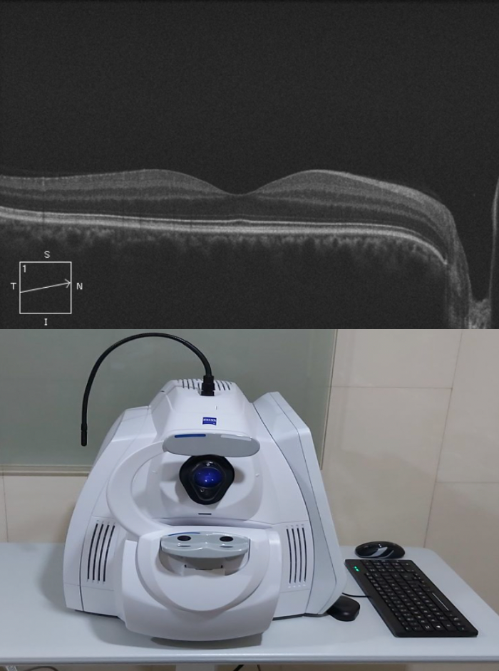 OCT de segmento posterior Zeiss Cirrus - ejemplo macular